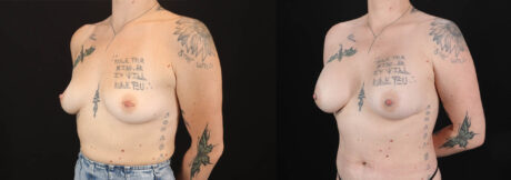 Breast Augmentation case #263023