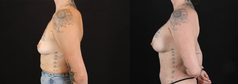 Breast Augmentation case #263023