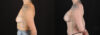Breast Augmentation case #263023 slider thumbnail