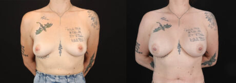 Breast Augmentation case #263023
