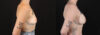 Breast Augmentation case #263023 slider thumbnail