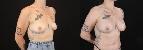 Breast Augmentation case #263023