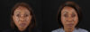 Botox® & Other Neuromodulators case #262991 slider thumbnail