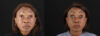 Botox® & Other Neuromodulators case #262991 slider thumbnail