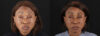 Botox® & Other Neuromodulators case #262991 slider thumbnail