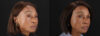 Botox® & Other Neuromodulators case #262991 slider thumbnail