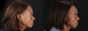 Botox® & Other Neuromodulators case #262991 slider thumbnail