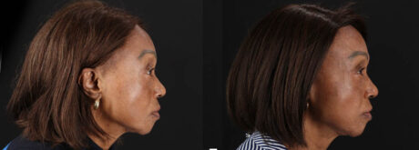 Botox® & Other Neuromodulators case #262991