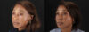Botox® & Other Neuromodulators case #262991 slider thumbnail