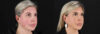 Renuvion RF Skin Tightening case #263029 slider thumbnail