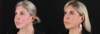 Renuvion RF Skin Tightening case #263029 slider thumbnail