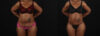 Post Bariatric Surgery (Massive Weight Loss) case #262974 slider thumbnail