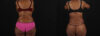 Post Bariatric Surgery (Massive Weight Loss) case #262974 slider thumbnail