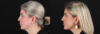 Renuvion RF Skin Tightening case #263029 slider thumbnail