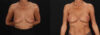 Breast Augmentation case #263455 slider thumbnail