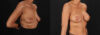 Breast Augmentation case #263455 slider thumbnail