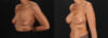Breast Augmentation case #263455 slider thumbnail