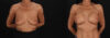 Breast Augmentation case #263455 slider thumbnail