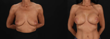 Breast Augmentation case #263455