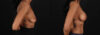 Breast Augmentation case #263455 slider thumbnail
