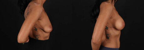 Breast Augmentation case #263455