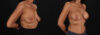 Breast Augmentation case #263455 slider thumbnail