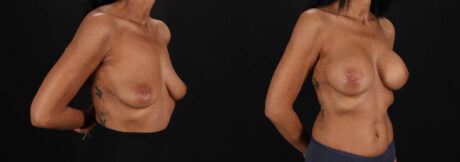 Breast Augmentation case #263455