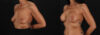 Breast Augmentation case #263455 slider thumbnail
