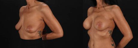Breast Augmentation case #263455