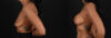 Breast Augmentation case #263455 slider thumbnail