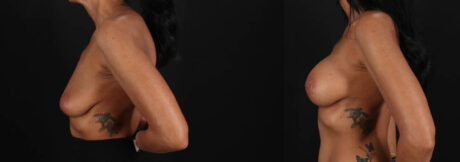 Breast Augmentation case #263455
