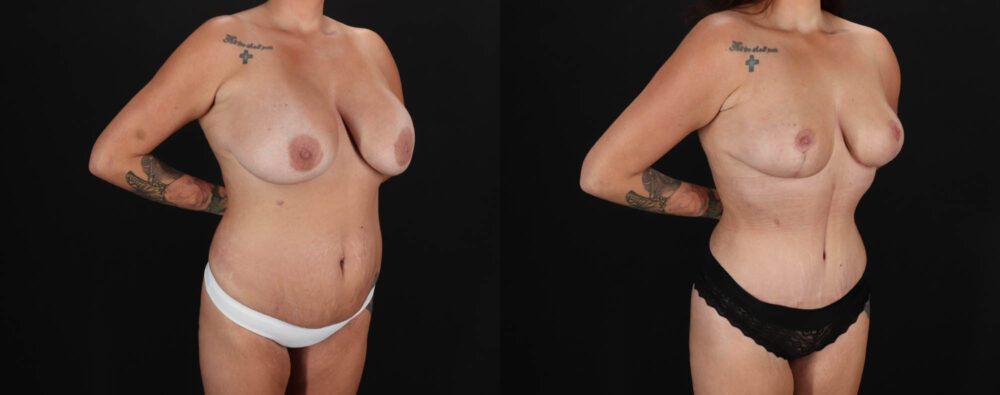 Mommy Makeover case #263966