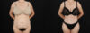 Tummy Tuck case #263466 slider thumbnail