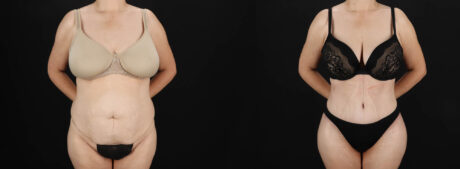 Tummy Tuck case #263466