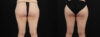 Tummy Tuck case #263466 slider thumbnail