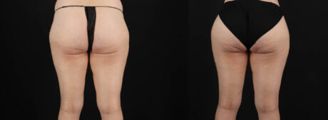 Tummy Tuck case #263466