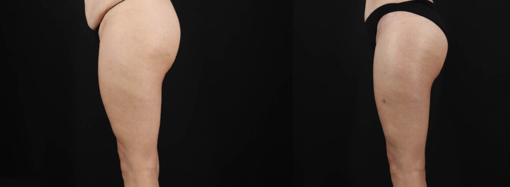 Tummy Tuck case #263466