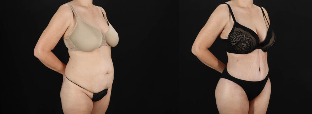 Tummy Tuck case #263466