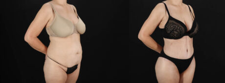 Tummy Tuck case #263466