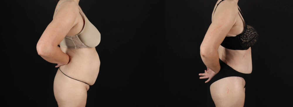 Tummy Tuck case #263466
