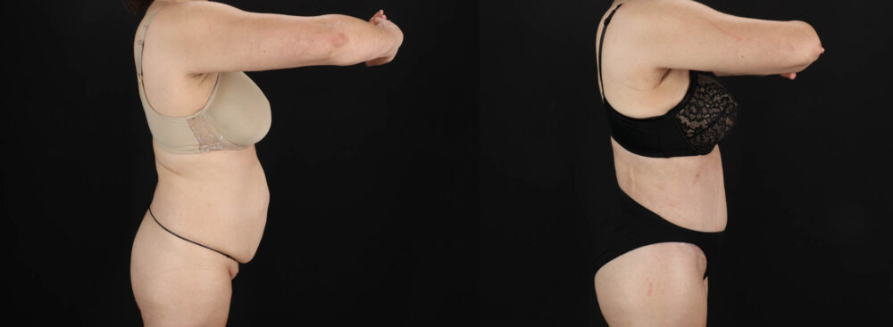 Tummy Tuck case #263466