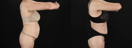 Tummy Tuck case #263466