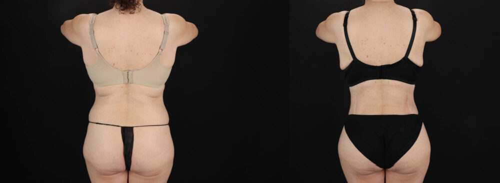 Tummy Tuck case #263466