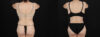 Tummy Tuck case #263466 slider thumbnail