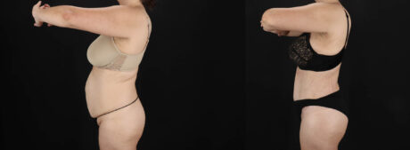 Tummy Tuck case #263466