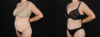 Tummy Tuck case #263466 slider thumbnail