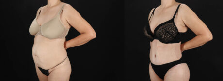 Tummy Tuck case #263466