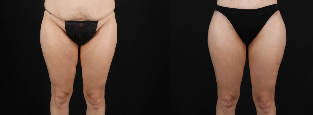 Tummy Tuck case #263466