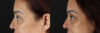 Blepharoplasty case #263975 slider thumbnail