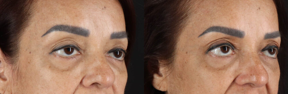 Blepharoplasty case #263975